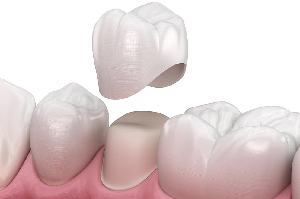 Corona su denti naturali