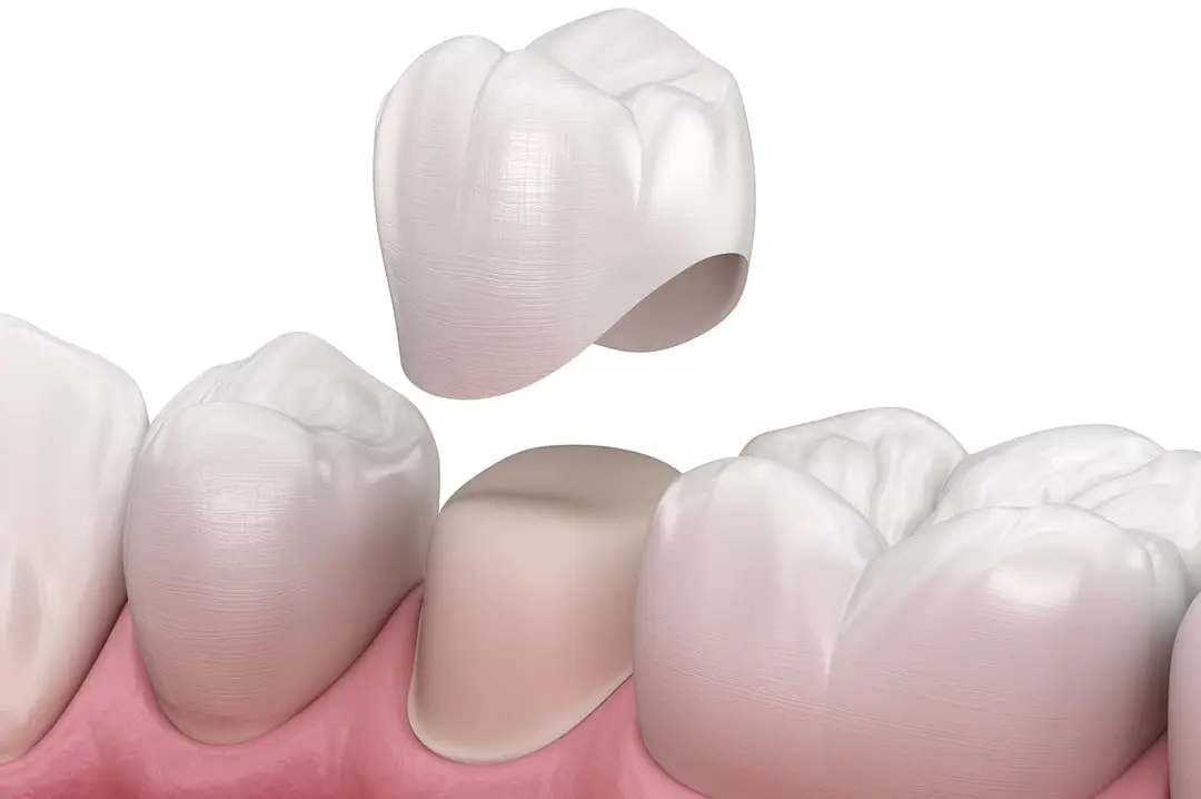 Corona su dente naturale