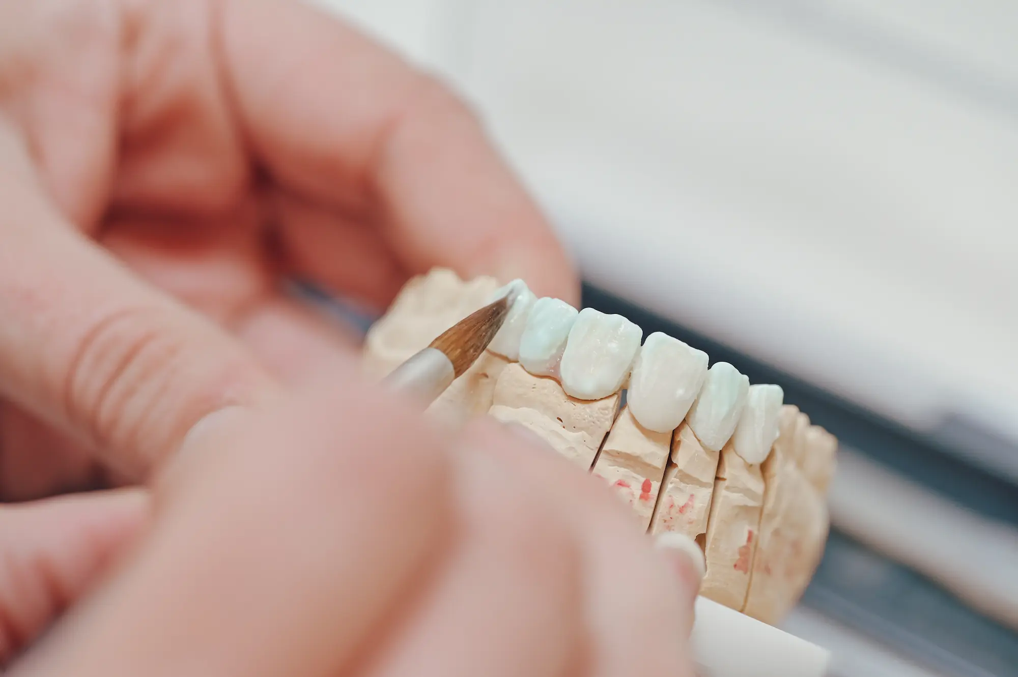 Soluzione protesica su denti naturali nella clinica Dental Professionals