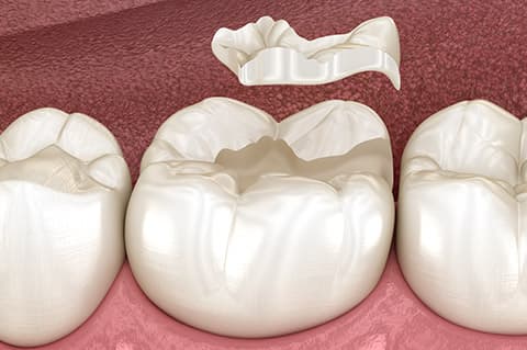 Otturazioni in ceramica e composito