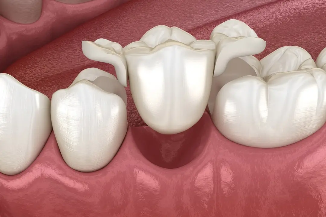Ponte su denti naturali