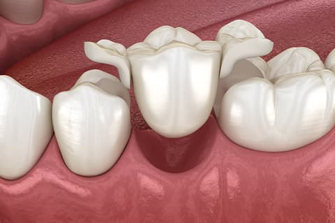 Ponte su denti naturali