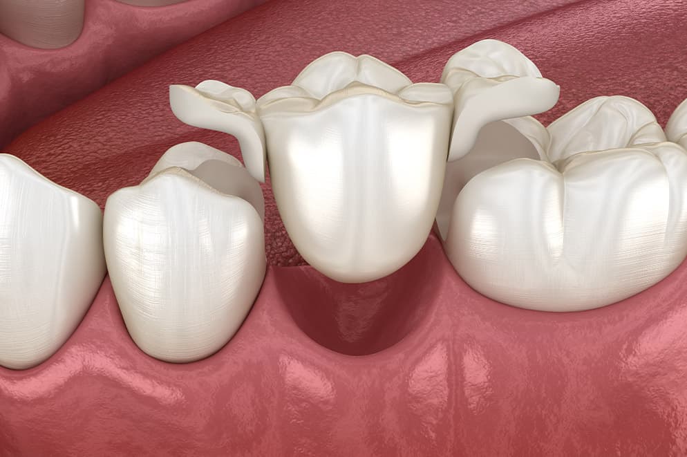 Ponte su denti naturali