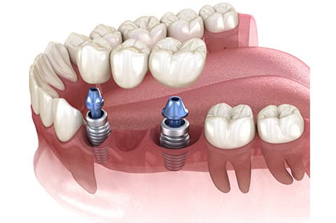 Ponti sugli impianti