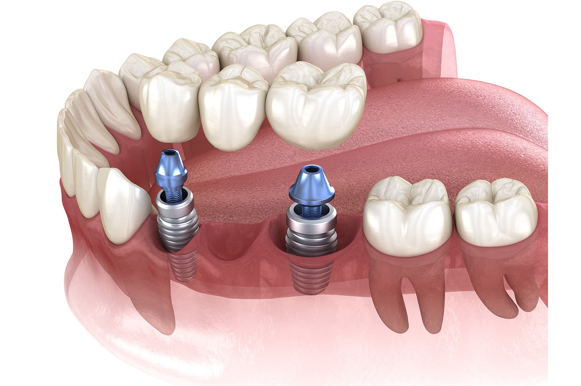 Ponti sugli impianti