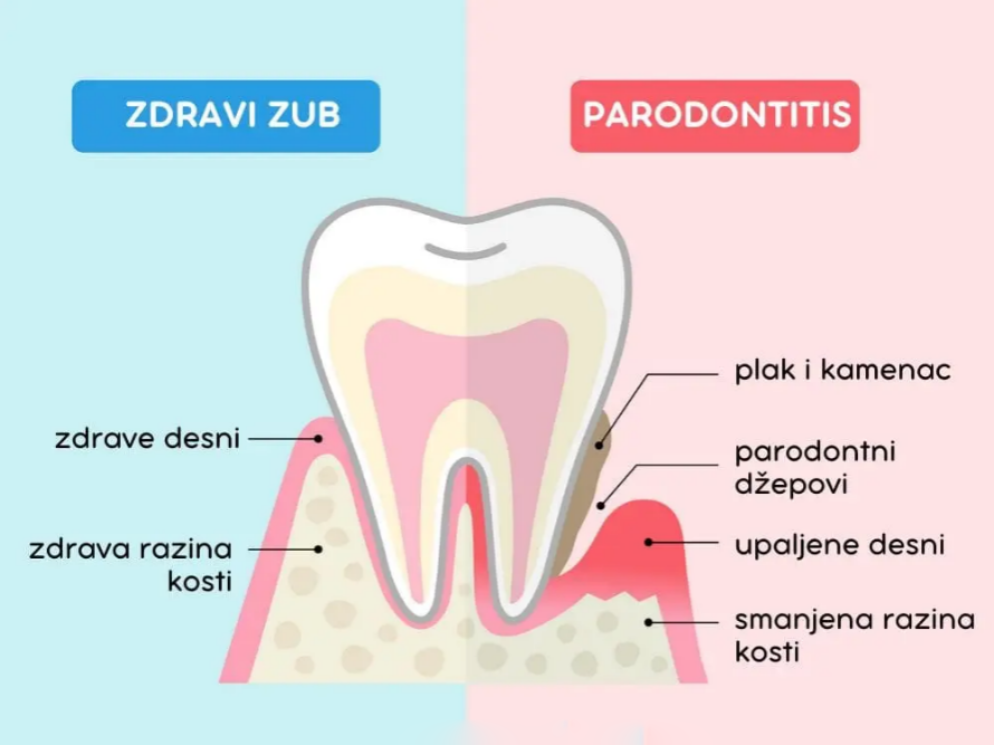 Gingivitis